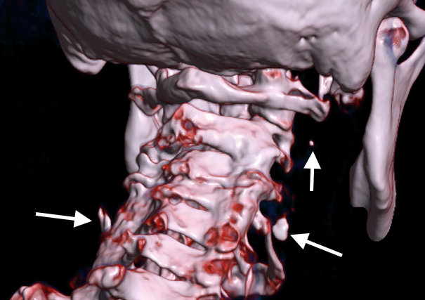 Three-dimensional CT reconstruction of the head and neck with arrows marking several areas selected for further review.